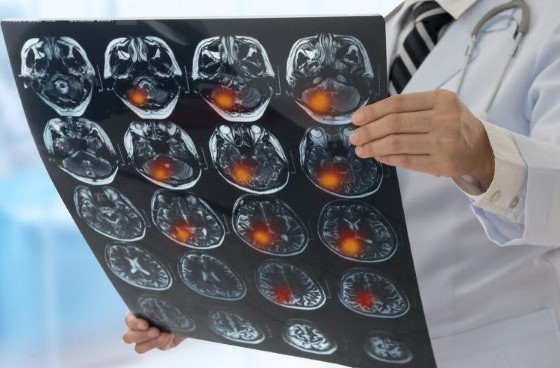 CT mozgu je nevyhnutnou súčasťou série vyšetrenia pri diagnostike mŕtvice samotnej, ale aj jej typu